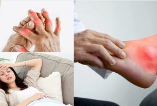 High Uric Acid