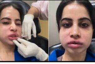 urfi javed,urfi javed face,urfi javed ko kya hua,urfi javed lip fillers,urfi javed lip,urfi javed news,urfi javed lip fillers gone news,urfi