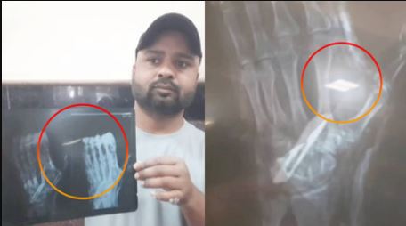 Bikaner News, Hospital negligence , अस्पताल में लापरवाही , Medical malpractice , Surgical blade in plaster , Child patient safety , PBM hospital incident , Health system accountability , Hospital administration"